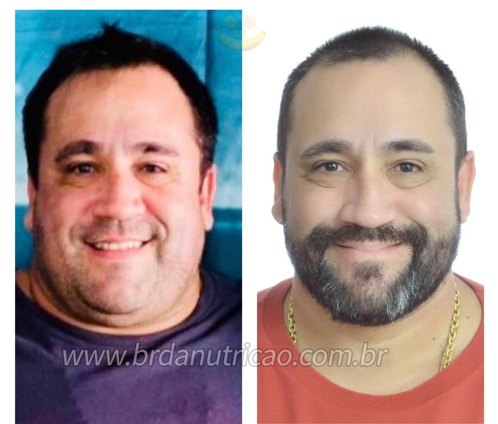 antes e depois cirurgia bariatrica