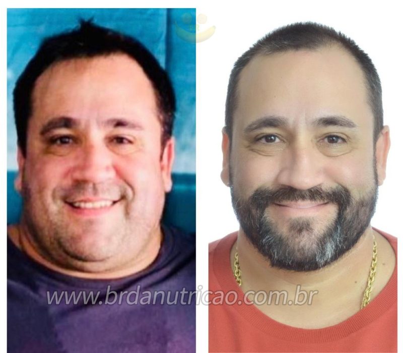 antes e depois cirurgia bariatrica